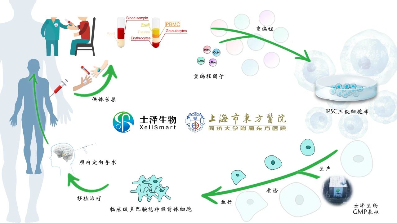 士泽生物开创新纪元：iPS细胞治疗帕金森病获批国家级临床研究